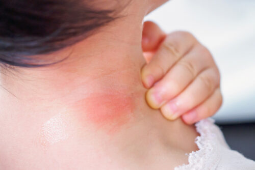 Small rash on child's neck