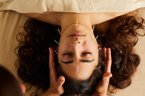 woman getting acupuncture