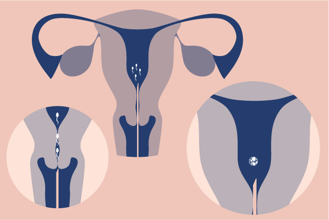 Graphic showing the 3 versions of the reproductive system in a female that represents different types of artificial insemination.