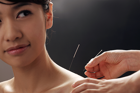 A person having acupuncture performed to help with fertility.